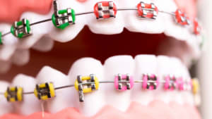 The basics of orthodontics