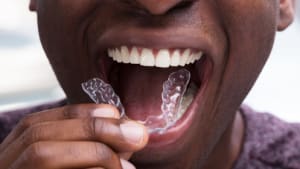 The dangers of DIY orthodontics